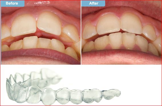 https://www.javeaonline24.com/images/braces_for_teeth_costa_blanca.jpg